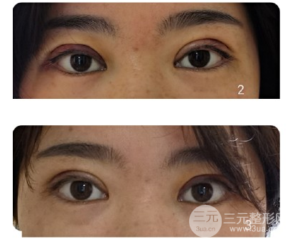 雙眼皮手術(shù)疼嗎