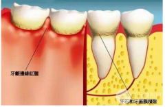 牙結(jié)石洗牙能洗掉嗎？有什么危害