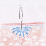 原來注射瘦腿副作用有這三點(diǎn)！集美們快來看！