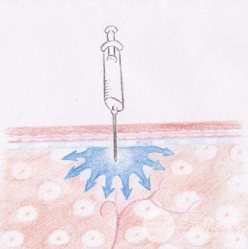 注射瘦腿副作用