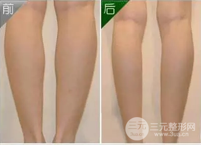 注射瘦腿副作用