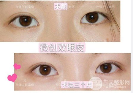 三點定位雙眼皮手術(shù)記錄