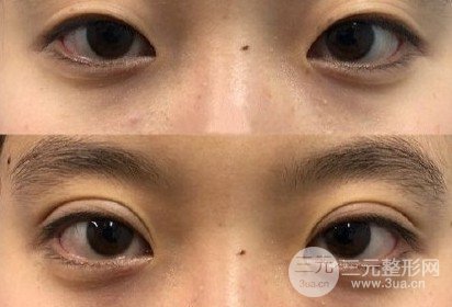 三點定位雙眼皮手術(shù)記錄