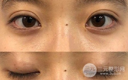三點定位雙眼皮手術(shù)記錄