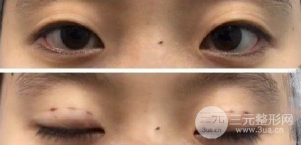 三點定位雙眼皮手術(shù)記錄