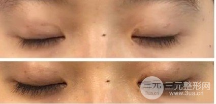 三點定位雙眼皮手術(shù)記錄