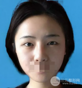 韓式翹睫雙眼皮真實感受：朋友說看不到痕跡