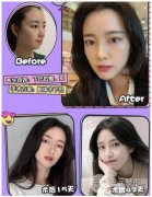 真實(shí)玻尿酸隆下巴日記，整個(gè)手術(shù)只用了半小時(shí)