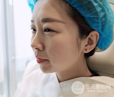 真實(shí)玻尿酸隆下巴日記