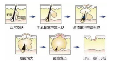 激光緩解痤瘡大概多少錢