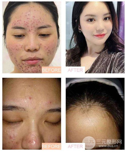 激光緩解痤瘡大概多少錢