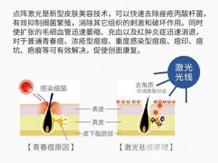 激光緩解痤瘡大概多少錢
