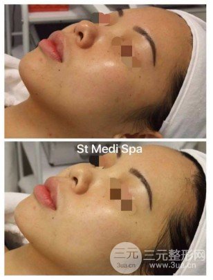 光子嫩膚黃褐斑原理