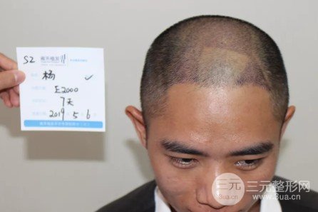 植發(fā)2000單位果圖