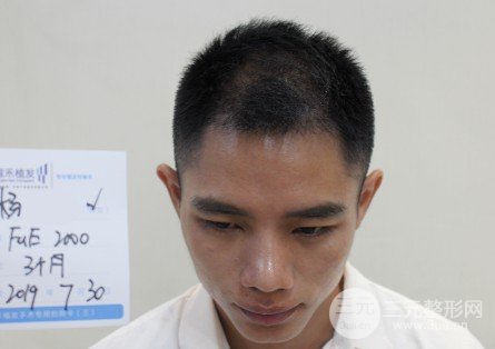 植發(fā)2000單位果圖