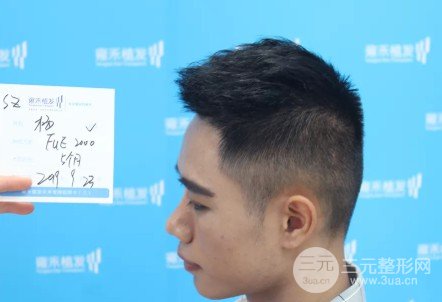 植發(fā)2000單位果圖