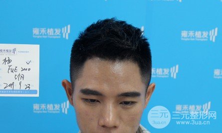 植發(fā)2000單位果圖