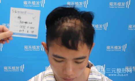 植發(fā)2000單位果圖