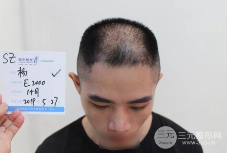 植發(fā)2000單位果圖