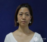 埋線雙眼皮20年后圖片，看過之后可能你就想做了！