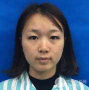 雙眼皮多項整形真實恢復(fù)期圖片，恢復(fù)過程記錄參考！