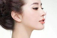 下巴短整形要怎么做？假體墊下巴案例