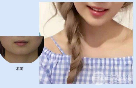 下巴短整形要怎么做
