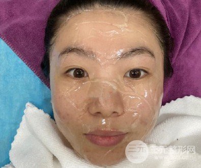 e光祛斑會(huì)反彈嗎