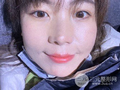 e光祛斑會(huì)反彈嗎