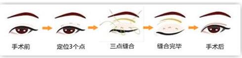 什么是韓式3點式雙眼皮?