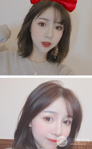 韓式3點式雙眼皮案例