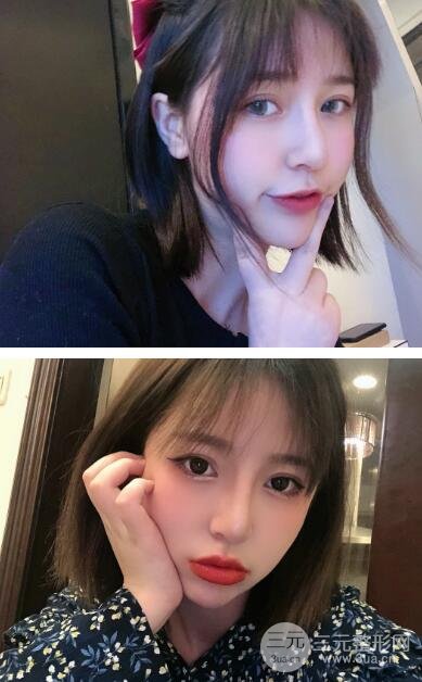 韓式3點式雙眼皮案例