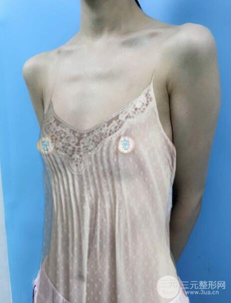 八大處脂肪隆胸案例