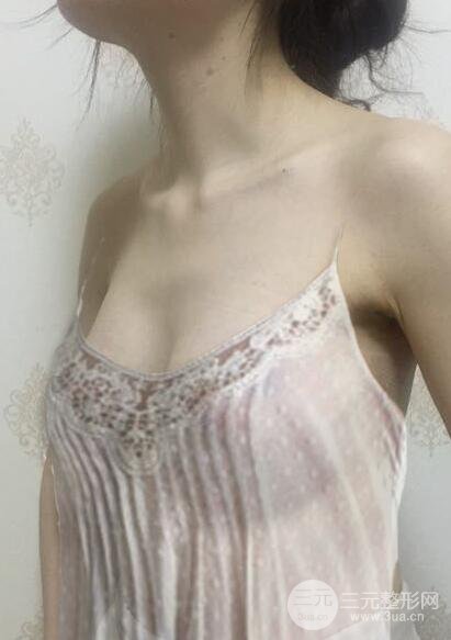 八大處脂肪隆胸案例