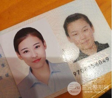 割雙眼皮手術(shù)圖片