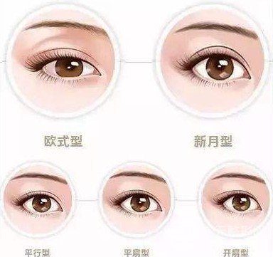 割雙眼皮手術(shù)圖片