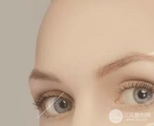 雙眼皮多項整形恢復(fù)過程圖真人日記參考，一次就能改變這么大？！