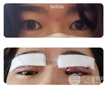 雙眼皮寬度6mm仔細(xì)看會假嗎？真人照片對比