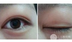 腫眼泡割了雙眼皮想死：不自然也是一種雙眼皮失敗