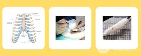 耳軟骨墊鼻尖多久消腫