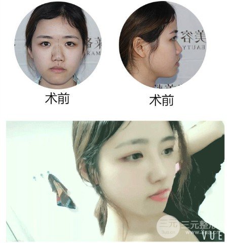 耳軟骨墊鼻尖多久消腫