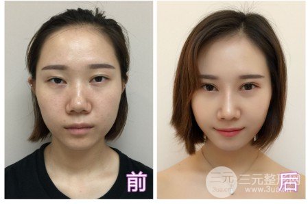 耳軟骨墊鼻尖多久消腫