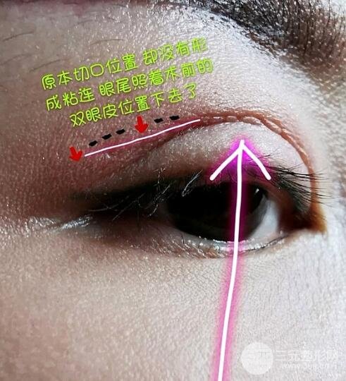 割雙眼皮的風(fēng)險(xiǎn)有哪些?