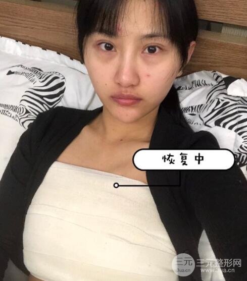 做完填充后的第1天