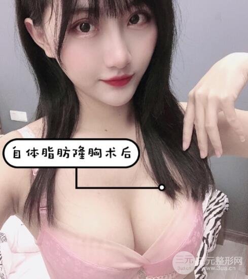 脂肪填充后一個(gè)月