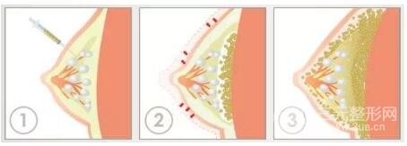 自體脂肪隆胸吸收很快嗎?