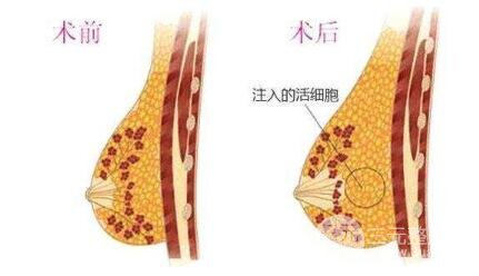 脂肪吸收率取決于這些因素