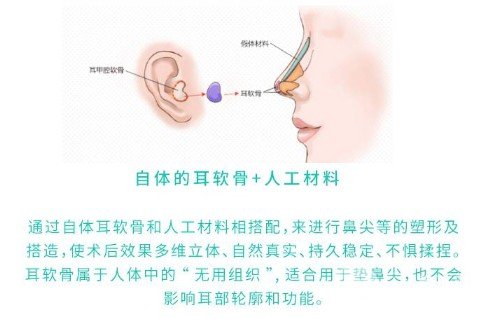 耳軟骨墊鼻尖吸收率很高嗎