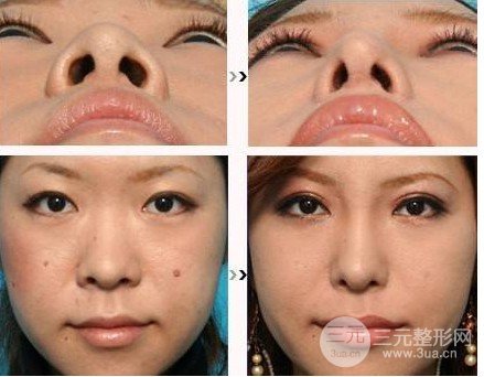 縮鼻翼前后對比照