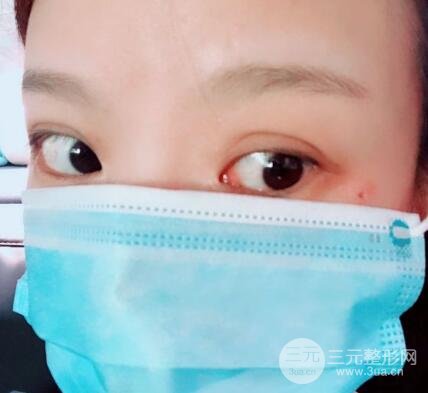 點(diǎn)痣的過(guò)程